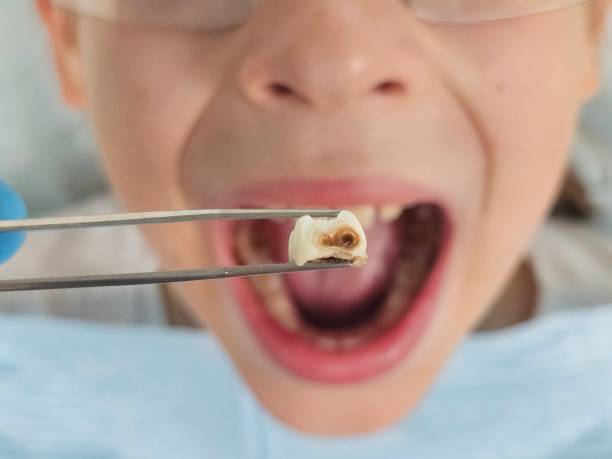 Best Knocked-Out Tooth (Avulsed Tooth) Treatment in Liberty, TX